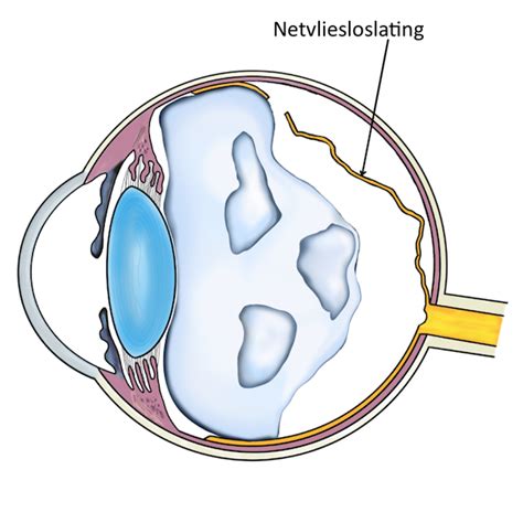 netvlies slijtage